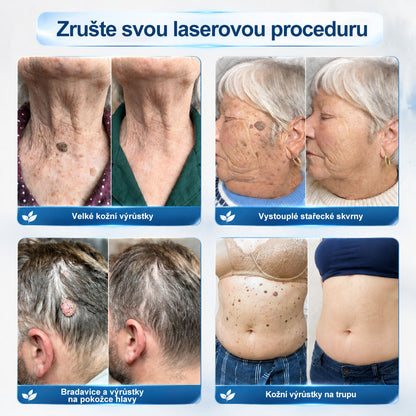 💎💎Oficiální značkový obchod | Hiskin® 7denní odstraňovač skvrn a pigmentových skvrn (Bezbolestný rollerball bez jizev)🐬