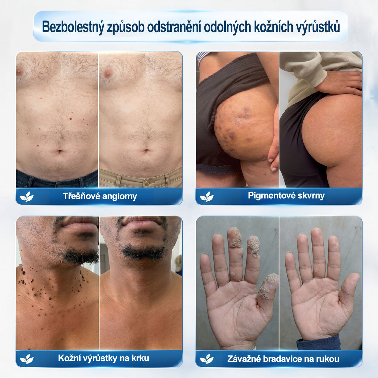 💎💎Oficiální značkový obchod | Hiskin® 7denní odstraňovač skvrn a pigmentových skvrn (Bezbolestný rollerball bez jizev)🐬