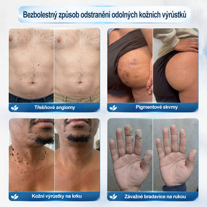 💎💎Oficiální značkový obchod | Hiskin® 7denní odstraňovač skvrn a pigmentových skvrn (Bezbolestný rollerball bez jizev)🐬