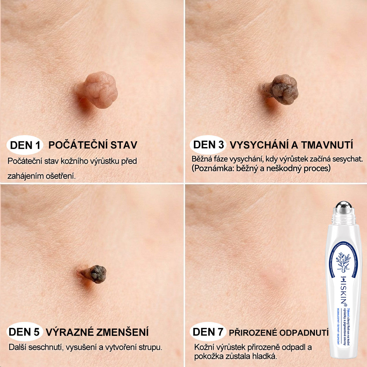 💎💎Oficiální značkový obchod | Hiskin® 7denní odstraňovač skvrn a pigmentových skvrn (Bezbolestný rollerball bez jizev)🐬